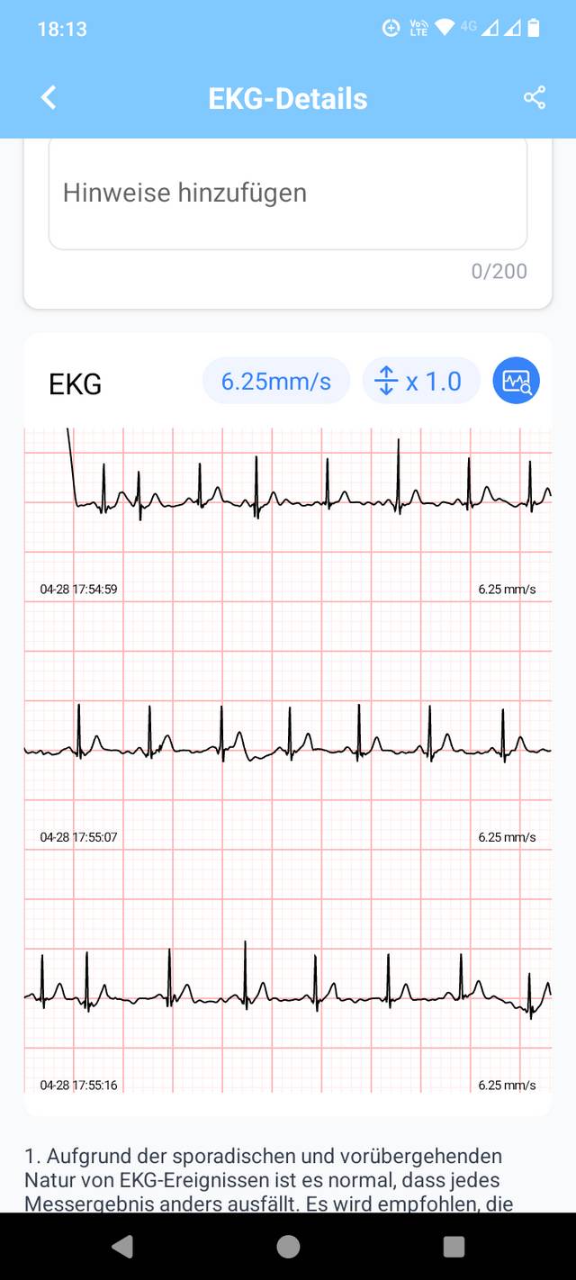 EKG-Aufzeichnung